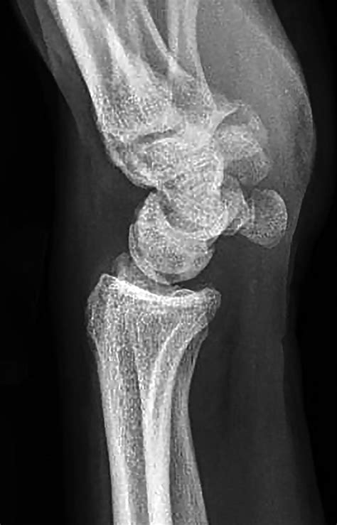 lunotriquetral ligament injury positive test